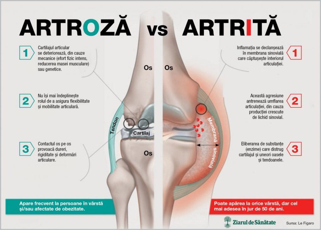 Artroză sau artrită cum faci diferența Better Medicine Zenyth